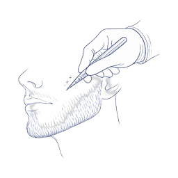 beard procedure