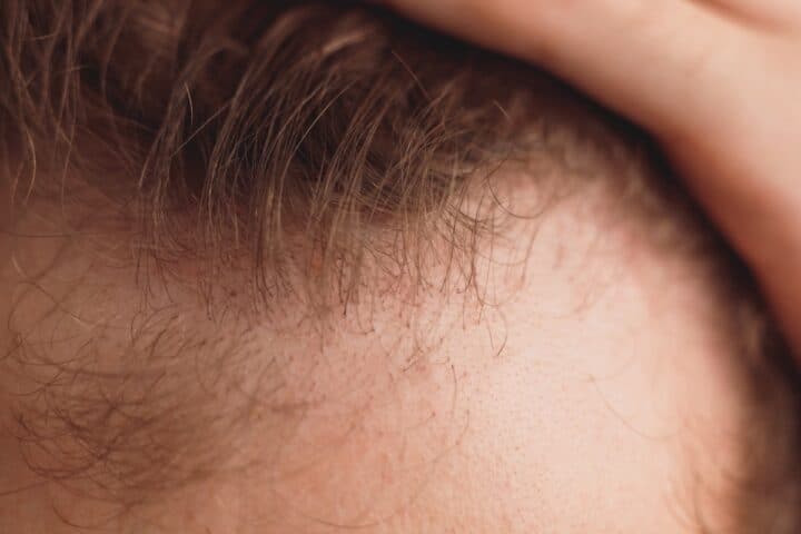diffusehairthinningandhairtransplant