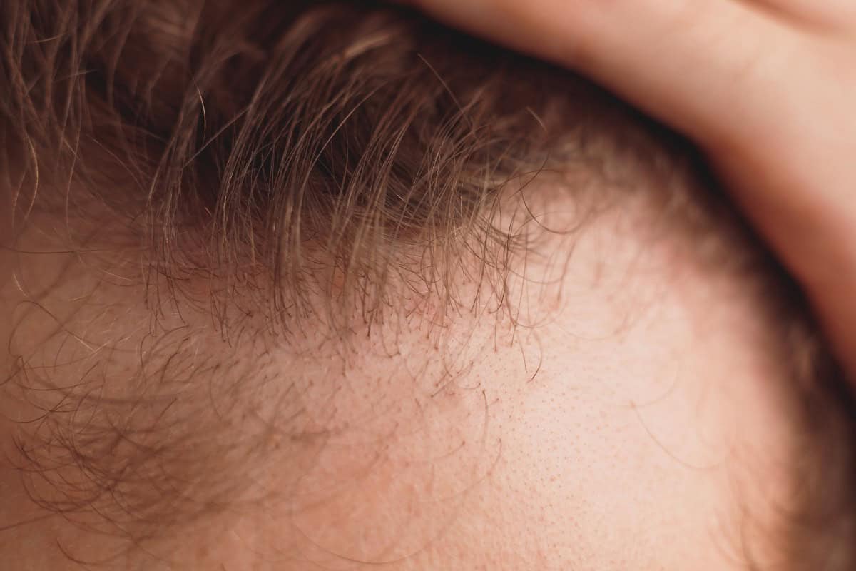diffusehairthinningandhairtransplant