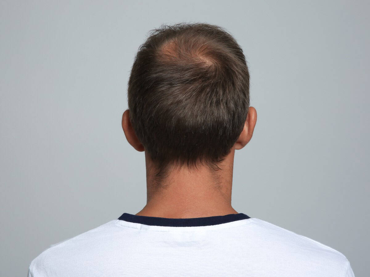 discover hair transplant success rates in thailand vs turkey