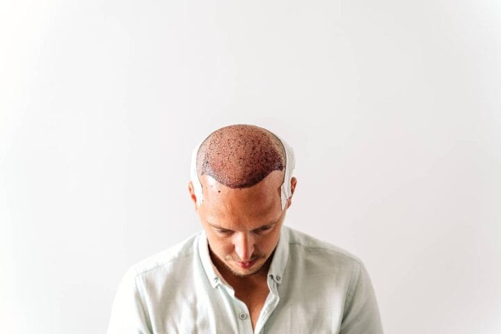 Hair transplant cost in Thailand