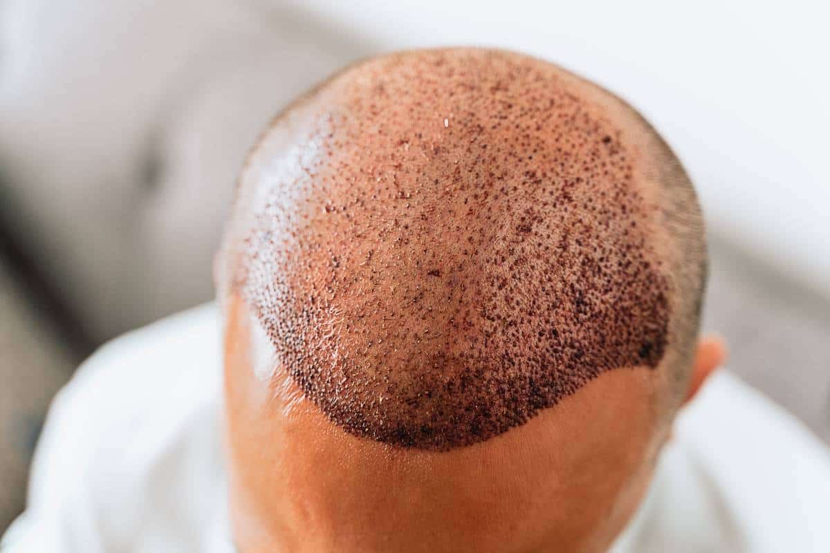 Hair Transplant Cost in Thailand: Complete Pricing Guide for 2026 Hair transplant cost in Thailand