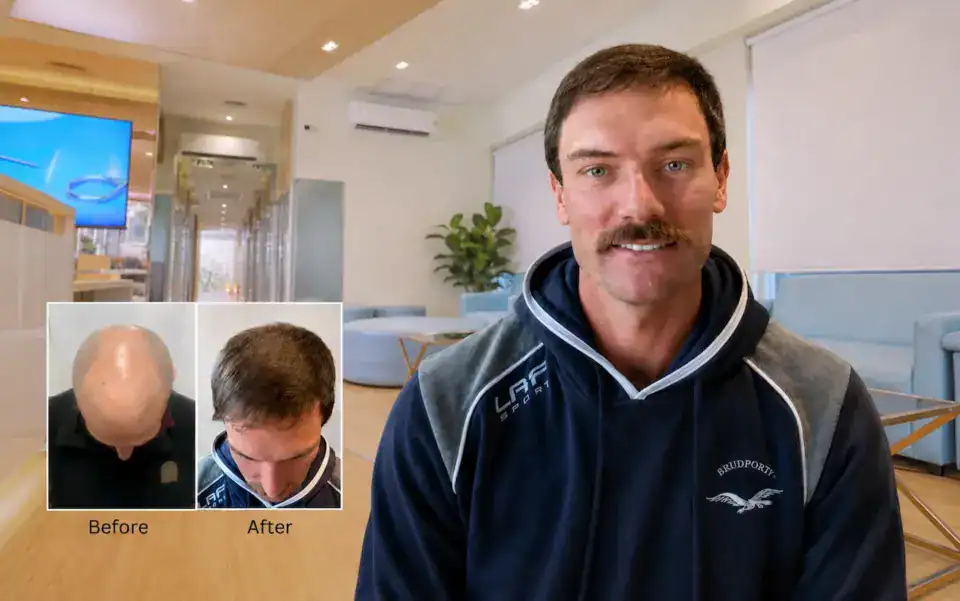 hair transplant revisions