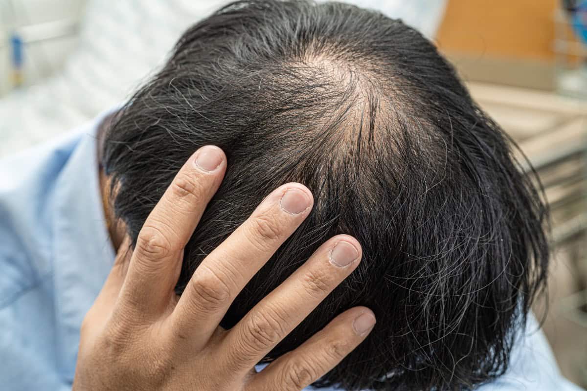 Close-up of thinning hair at the crown