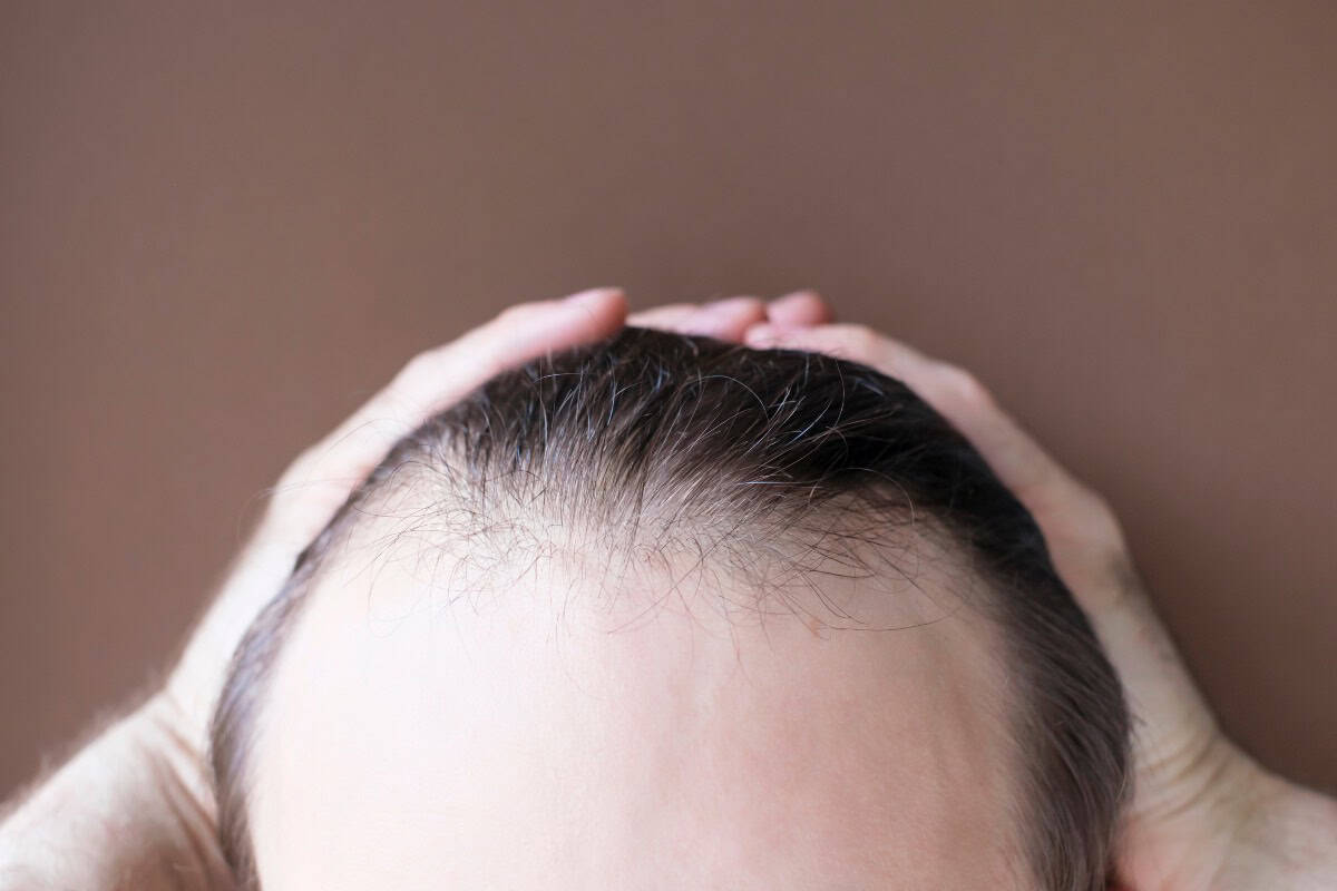 Close-up of a frontal hairline with hair held back