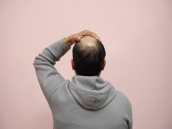 how many grafts do i need for a hair transplant