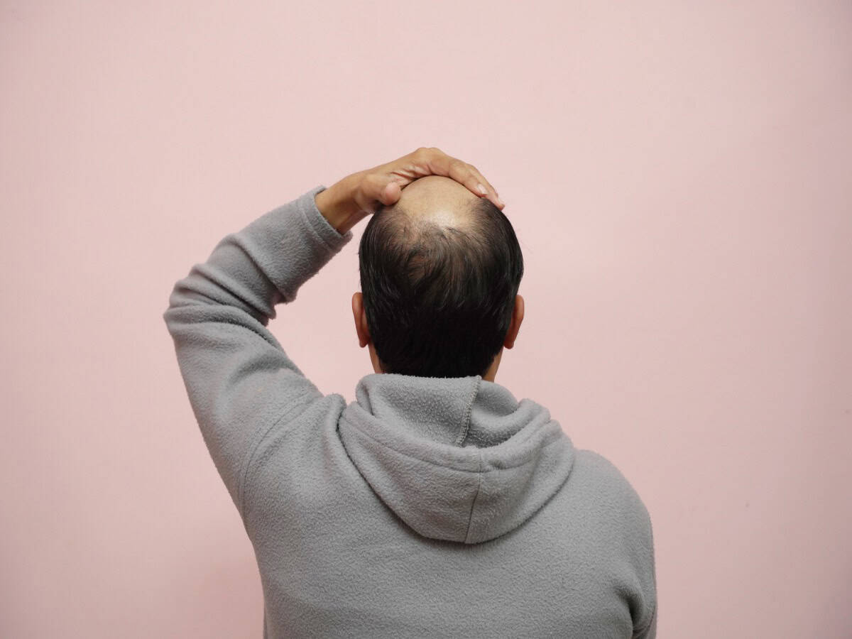 how many grafts do i need for a hair transplant
