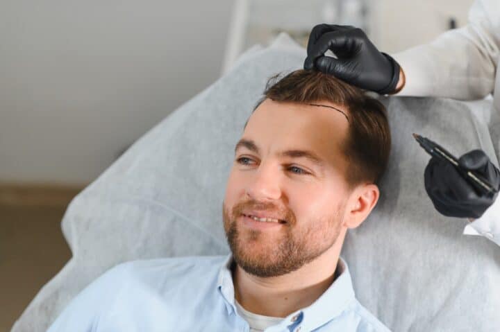 Hairline being marked during a consultation