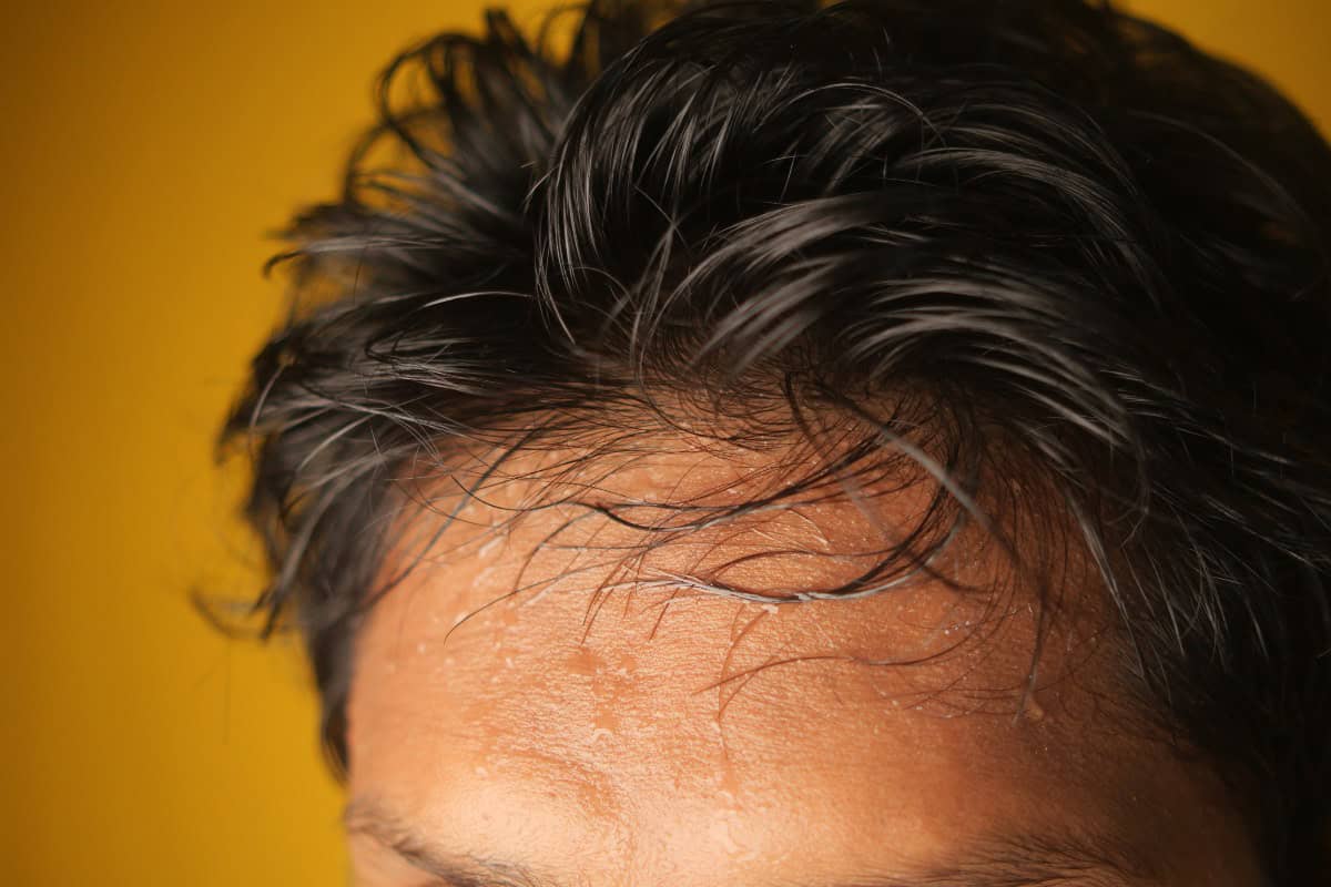 Close-up of a man's hairline