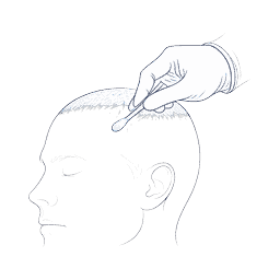 scalp preparation