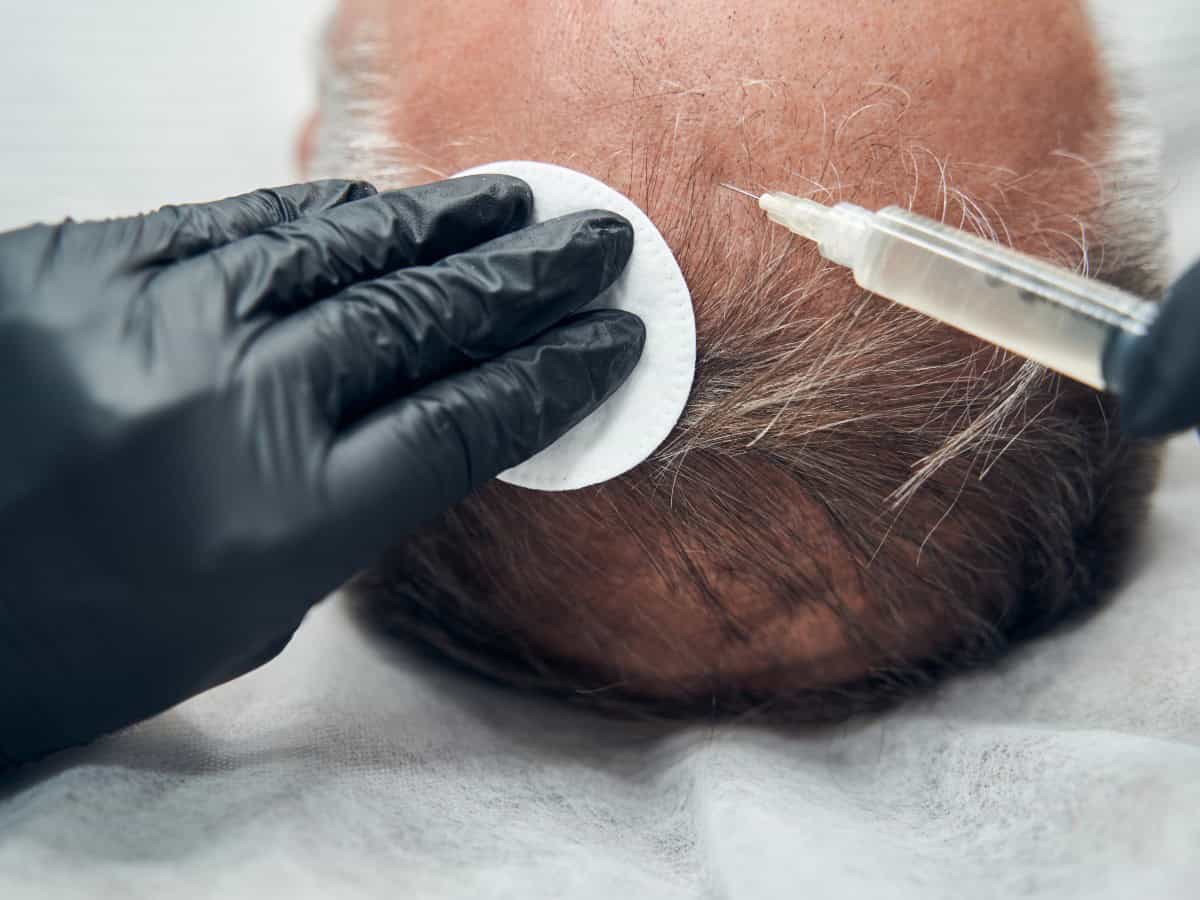 surgeon vs technician hair transplant