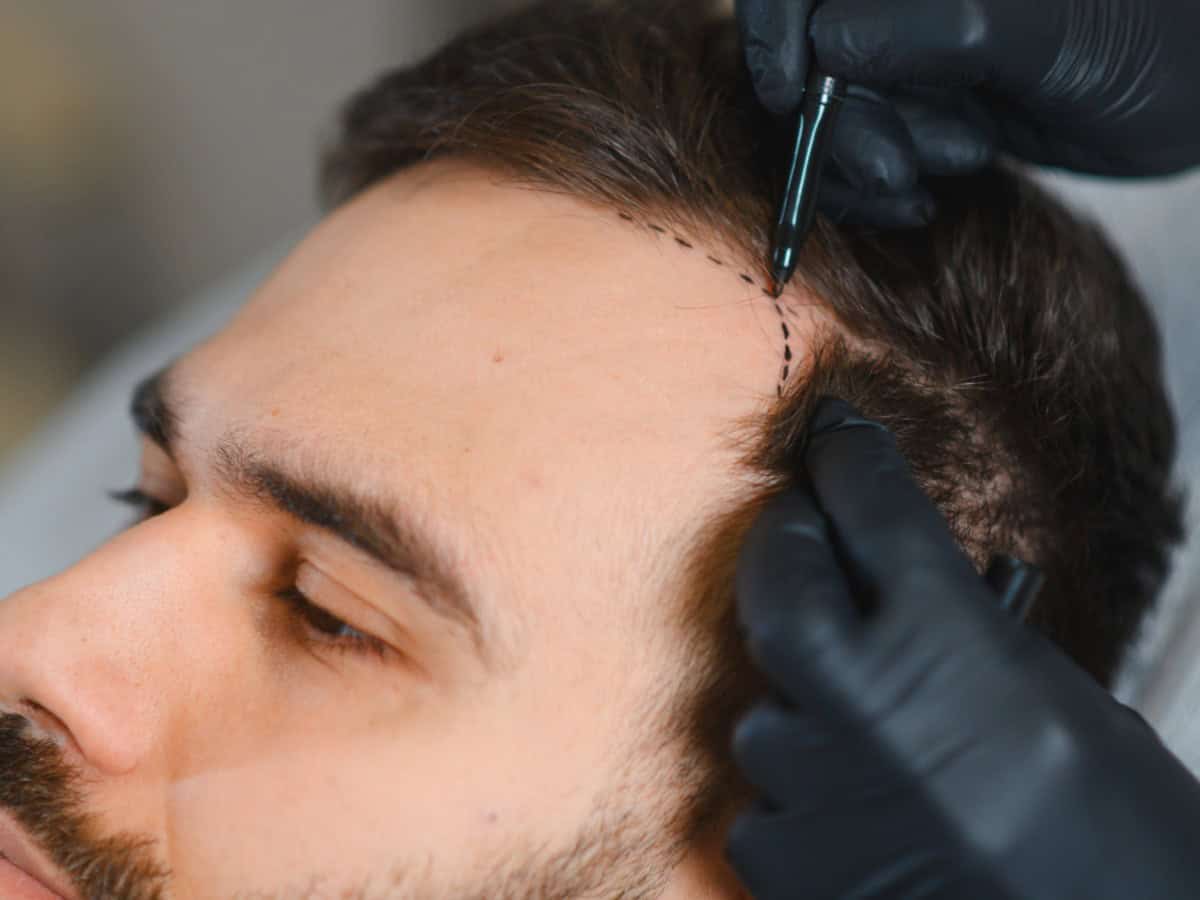 thailand vs turkey hair transplant safety explained 