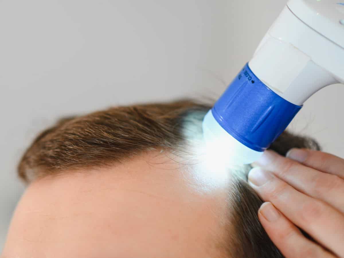 a trichologist examines the hair of a man who begins alopecia. consultation with a dermatologist. hair loss, alopecia, pruritus
