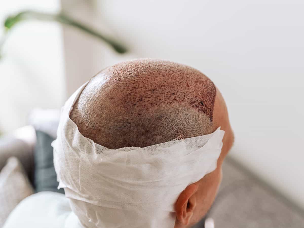 after hair transplantation surgical technique that moves hair follicles. young bald man in bandage with hair loss problems