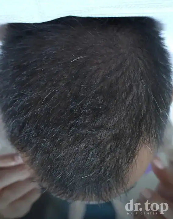 FUI Hair Transplant + PRP Hair Treatment + Stem Cell Hair Therapy (ALMI) + Combination Treatments after treatment — 12 months later — Dr. Top Hair Hospital