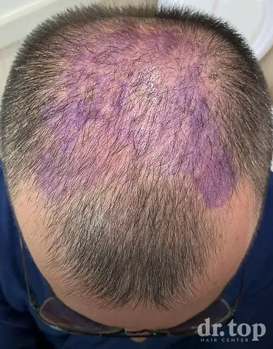 FUI Hair Transplant + PRP Hair Treatment + Stem Cell Hair Therapy (ALMI) + Combination Treatments before treatment — Dr. Top Hair Hospital