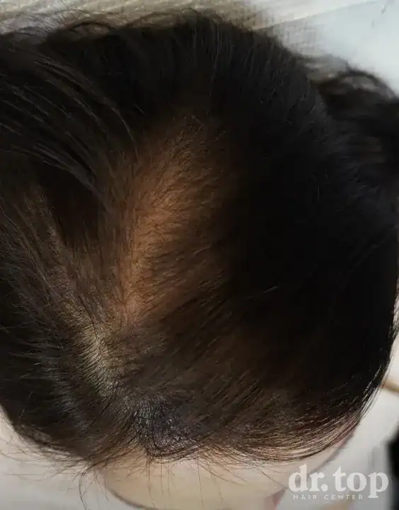 PRP Hair Treatment + Stem Cell Hair Therapy (ALMI) + Combination Treatments + Women's Hair Transplant after treatment — 10 months later — Dr. Top Hair Hospital