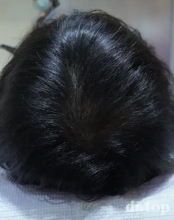 PRP Hair Treatment + Stem Cell Hair Therapy (ALMI) + Combination Treatments after treatment — 3 months later — Dr. Top Hair Hospital