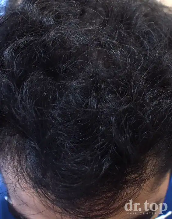 PRP Hair Treatment + Stem Cell Hair Therapy (ALMI) + Combination Treatments after treatment — 14 months later — Dr. Top Hair Hospital