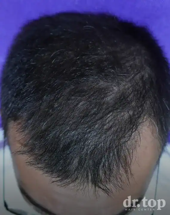 PRP Hair Treatment + Stem Cell Hair Therapy (ALMI) after treatment — 12 months later — Dr. Top Hair Hospital