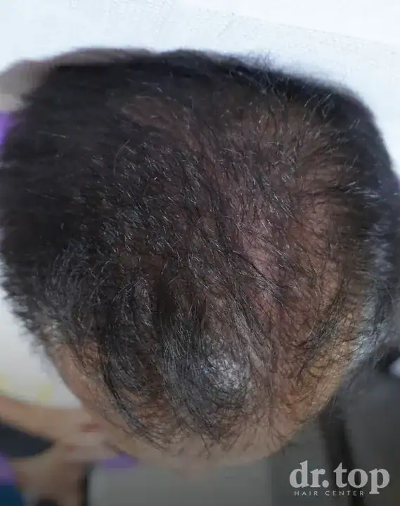 PRP Hair Treatment + Stem Cell Hair Therapy (ALMI) + Combination Treatments after treatment — 8 months later — Dr. Top Hair Hospital