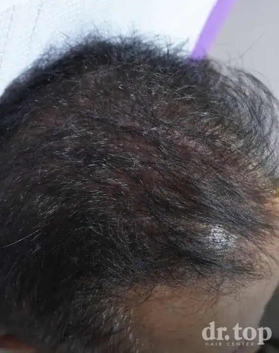 PRP Hair Treatment + Stem Cell Hair Therapy (ALMI) + Combination Treatments after treatment — 8 months later — Dr. Top Hair Hospital