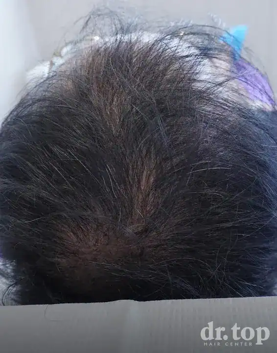 PRP Hair Treatment + Stem Cell Hair Therapy (ALMI) + Combination Treatments after treatment — 2 months later — Dr. Top Hair Hospital