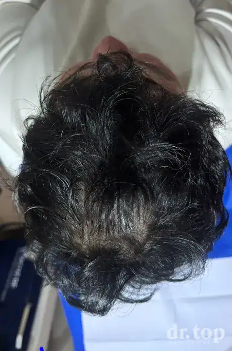 PRP Hair Treatment + Stem Cell Hair Therapy (ALMI) after treatment — 3 months later — Dr. Top Hair Hospital