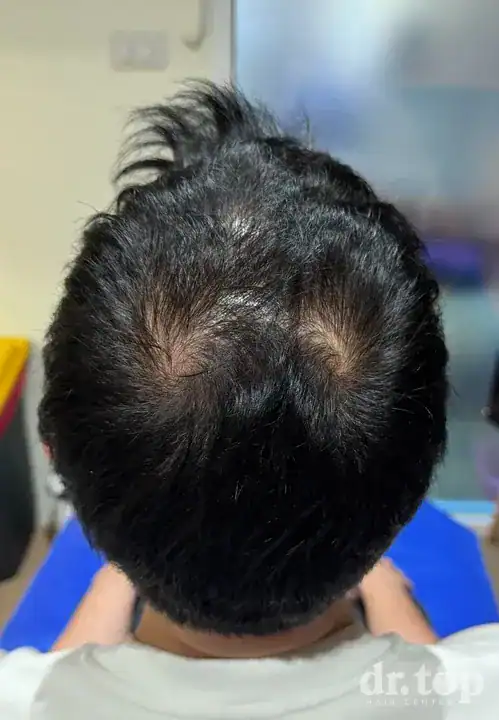 PRP Hair Treatment + Stem Cell Hair Therapy (ALMI) + Combination Treatments after treatment — 3 months later — Dr. Top Hair Hospital