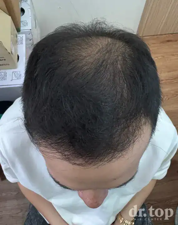PRP Hair Treatment + Stem Cell Hair Therapy (ALMI) + Combination Treatments after treatment — 5 months later — Dr. Top Hair Hospital