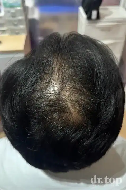 Stem Cell Hair Therapy (ALMI) + RF Microneedling (FRM) after treatment — 3 months later — Dr. Top Hair Hospital