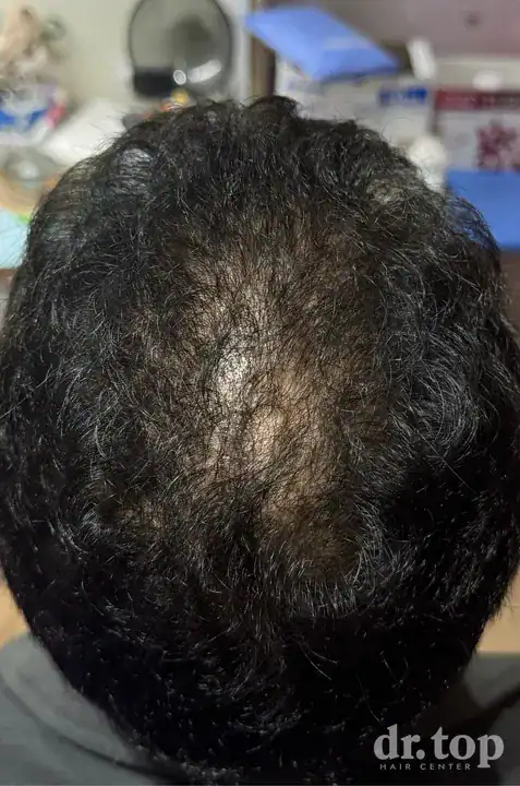PRP Hair Treatment + Stem Cell Hair Therapy (ALMI) after treatment — 3 months later — Dr. Top Hair Hospital