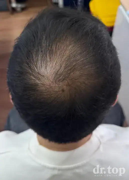PRP Hair Treatment + Stem Cell Hair Therapy (ALMI) + Combination Treatments after treatment — 4 months later — Dr. Top Hair Hospital