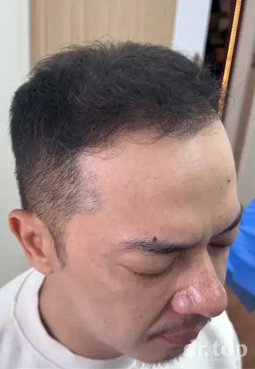 PRP Hair Treatment + Stem Cell Hair Therapy (ALMI) + Combination Treatments after treatment — 6 months later — Dr. Top Hair Hospital