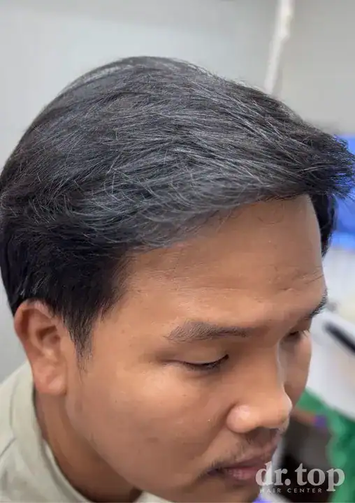 PRP Hair Treatment + Stem Cell Hair Therapy (ALMI) after treatment — 6 months later — Dr. Top Hair Hospital