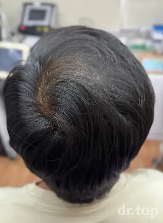PRP Hair Treatment + Stem Cell Hair Therapy (ALMI) + Combination Treatments after treatment — 3 months later — Dr. Top Hair Hospital