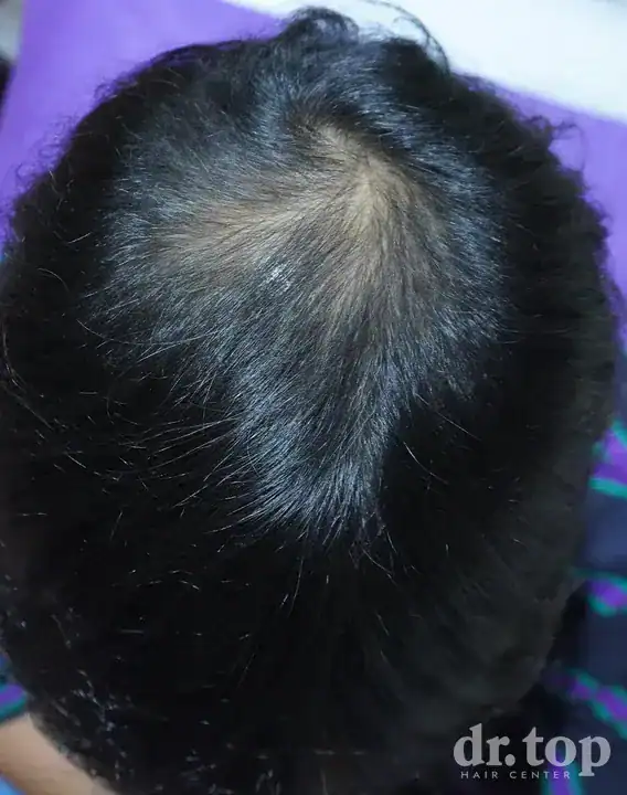 PRP Hair Treatment + Stem Cell Hair Therapy (ALMI) + Combination Treatments after treatment — 3 months later — Dr. Top Hair Hospital