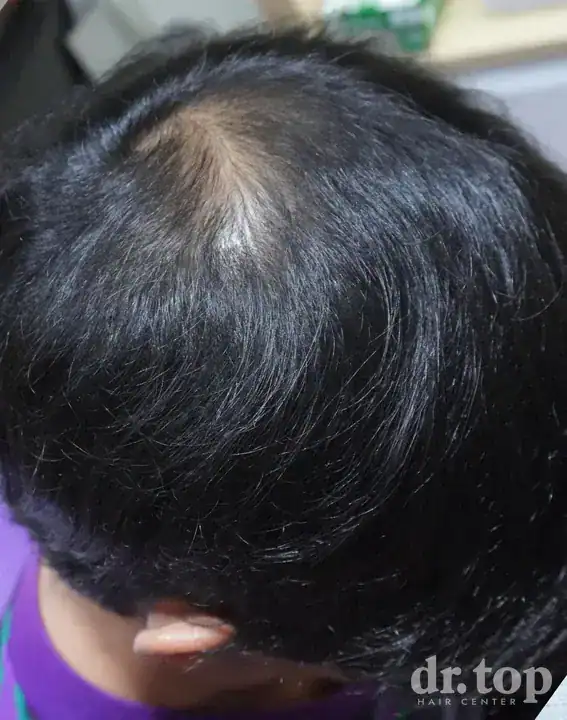 PRP Hair Treatment + Stem Cell Hair Therapy (ALMI) + Combination Treatments after treatment — 3 months later — Dr. Top Hair Hospital