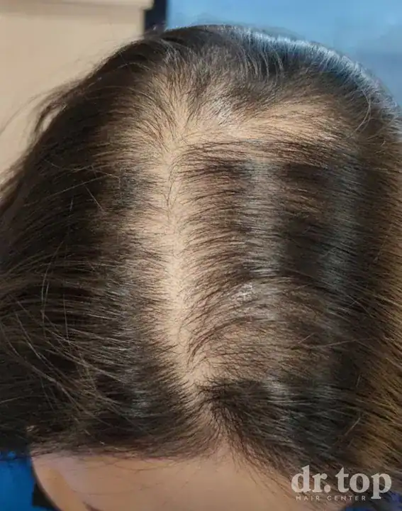 PRP Hair Treatment + Stem Cell Hair Therapy (ALMI) + Combination Treatments + Women's Hair Transplant before treatment — Dr. Top Hair Hospital