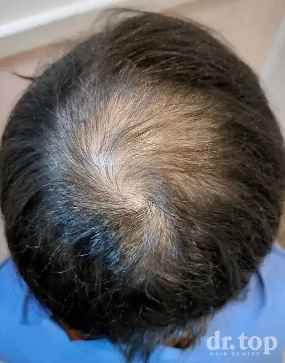 PRP Hair Treatment + Stem Cell Hair Therapy (ALMI) + Combination Treatments before treatment — Dr. Top Hair Hospital