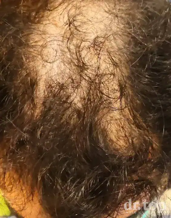 PRP Hair Treatment + Stem Cell Hair Therapy (ALMI) + Combination Treatments before treatment — Dr. Top Hair Hospital