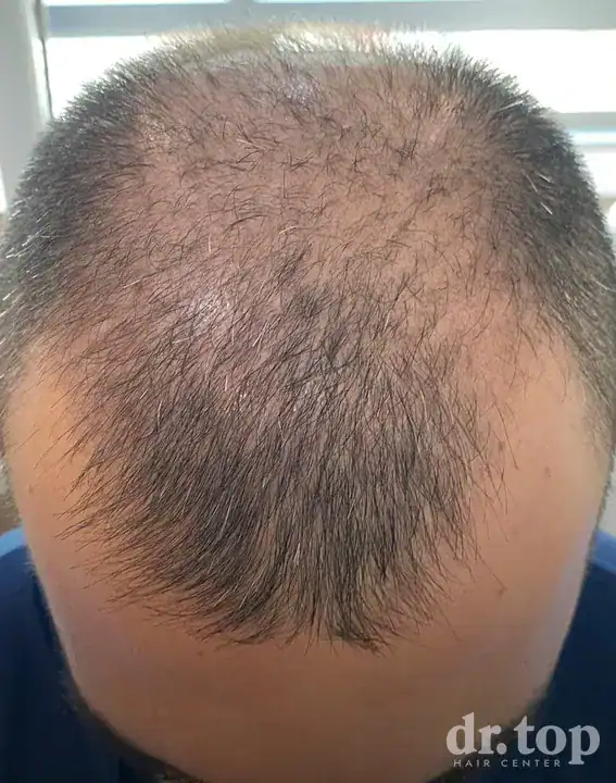 PRP Hair Treatment + Stem Cell Hair Therapy (ALMI) before treatment — Dr. Top Hair Hospital