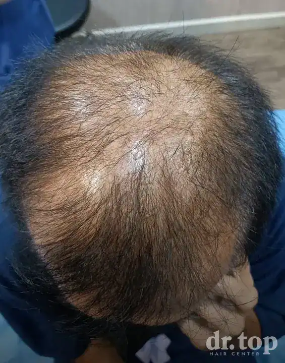 PRP Hair Treatment + Stem Cell Hair Therapy (ALMI) + Combination Treatments before treatment — Dr. Top Hair Hospital