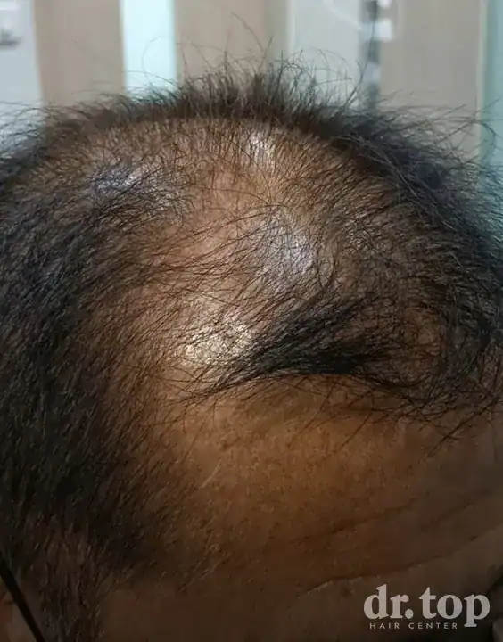 PRP Hair Treatment + Stem Cell Hair Therapy (ALMI) + Combination Treatments before treatment — Dr. Top Hair Hospital
