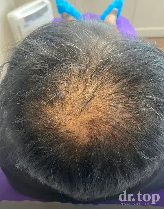 PRP Hair Treatment + Stem Cell Hair Therapy (ALMI) + Combination Treatments before treatment — Dr. Top Hair Hospital