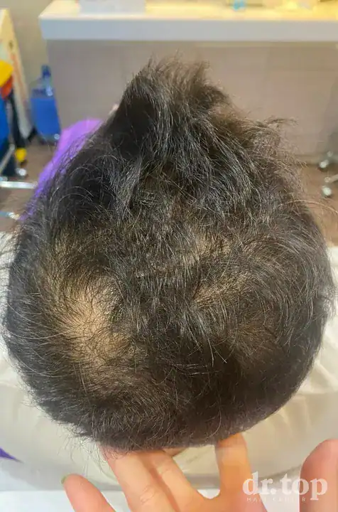 PRP Hair Treatment + Stem Cell Hair Therapy (ALMI) before treatment — Dr. Top Hair Hospital
