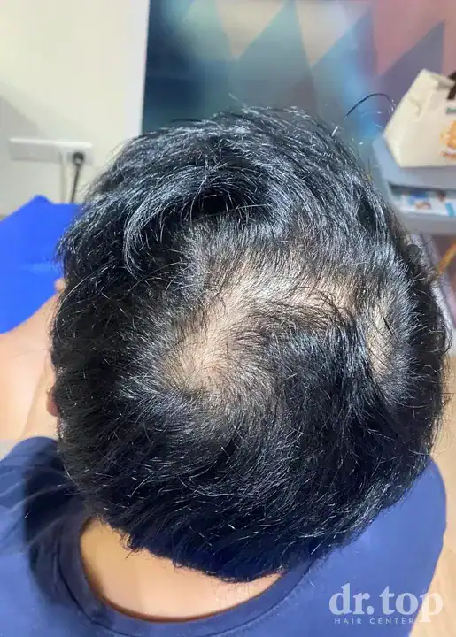 PRP Hair Treatment + Stem Cell Hair Therapy (ALMI) + Combination Treatments before treatment — Dr. Top Hair Hospital