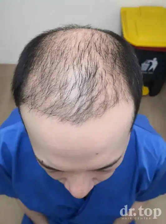 PRP Hair Treatment + Stem Cell Hair Therapy (ALMI) + Combination Treatments before treatment — Dr. Top Hair Hospital