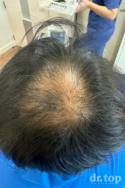 Stem Cell Hair Therapy (ALMI) + RF Microneedling (FRM) before treatment — Dr. Top Hair Hospital