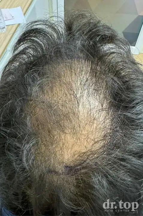 PRP Hair Treatment + Stem Cell Hair Therapy (ALMI) before treatment — Dr. Top Hair Hospital